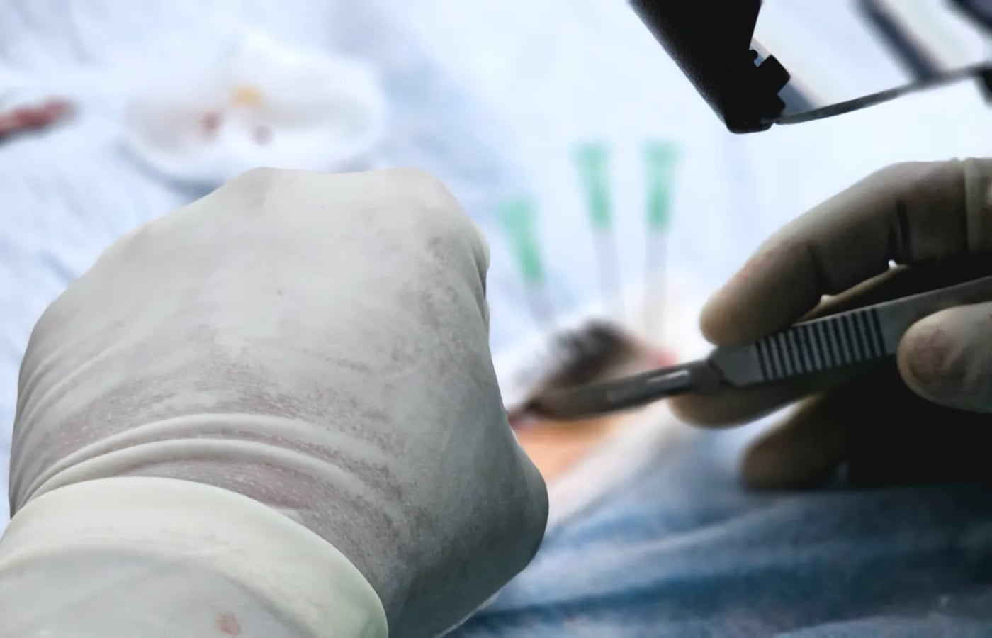 Hair transplant