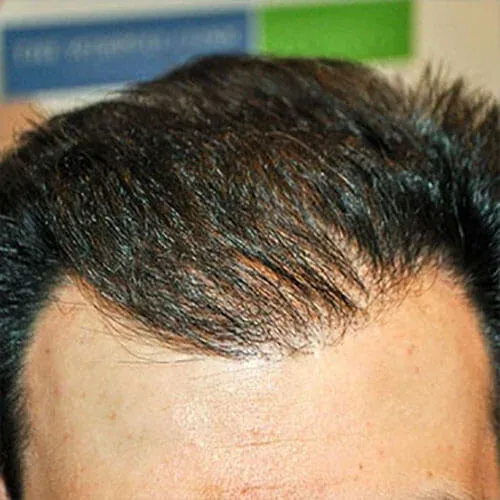 After — Sapphire FUE