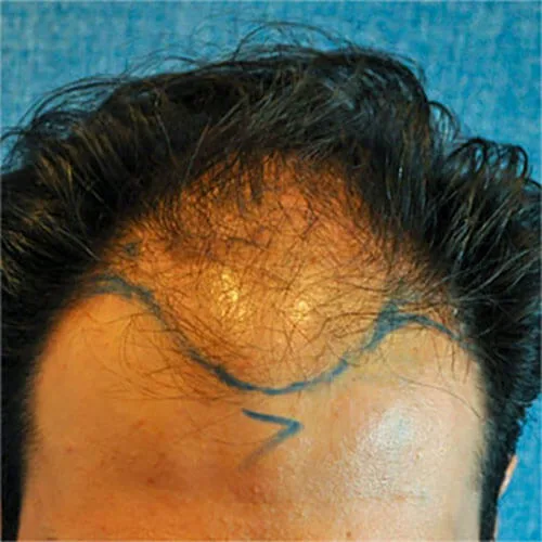 Before — Sapphire FUE