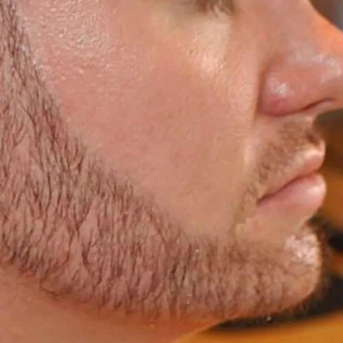 After — Beard transplant
