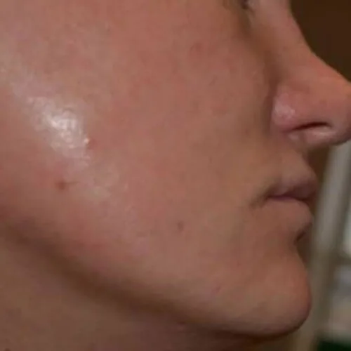 Before — Beard transplant