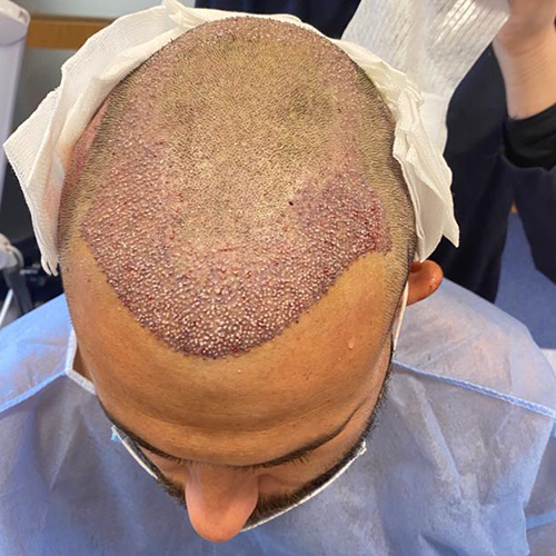 Après — Greffe de Cheveux