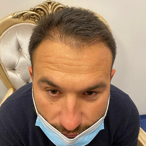 Avant — Greffe de Cheveux